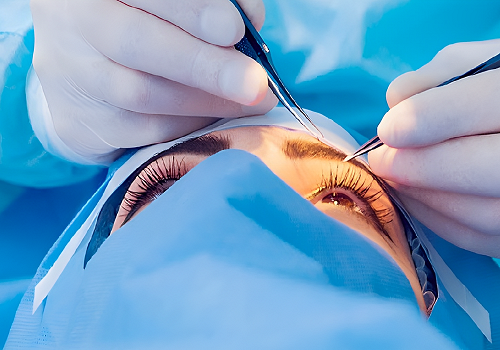 Cirugía de Glaucoma