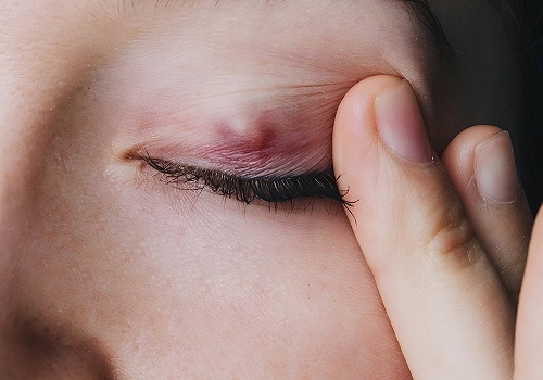 Cirugía de Chalazión