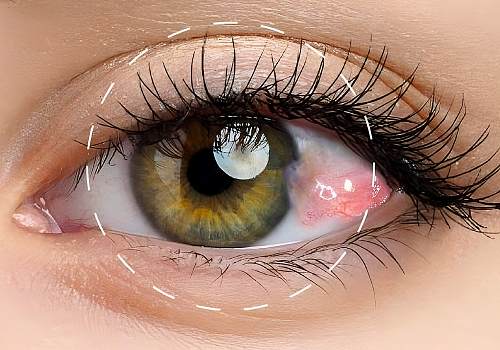 Cirugía de Pterigión (Carnosidad)